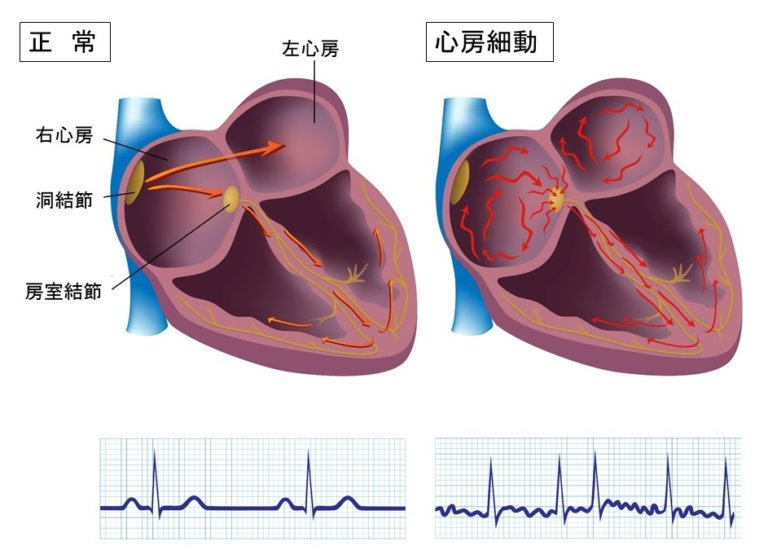 心房細動 | にしむら内科クリニック｜浦和の内科、消化器内科、内視鏡クリニックです。