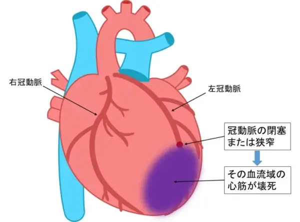 心筋が壊死した状態