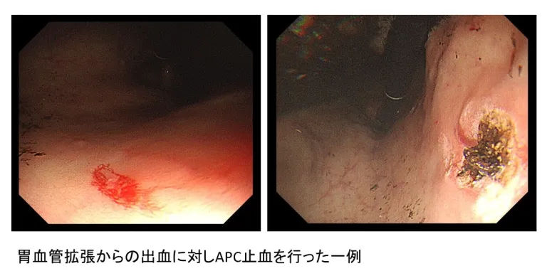 胃血管拡張からの出血に対しAPC止血を行った一例