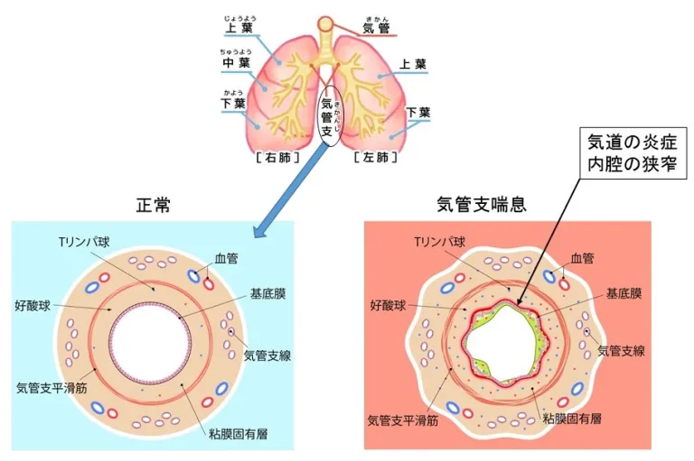 気管支喘息とは