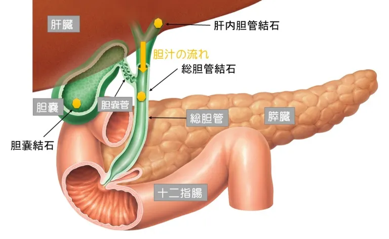 総胆管結石とは