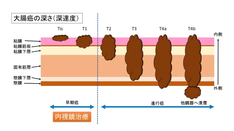 大腸癌の深さ（深達度）