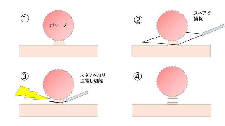 ポリペクトミーの場合の切除方法