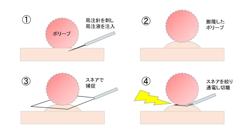 粘膜切除術（EMR：endoscopic mucosal resection）の場合の切除方法