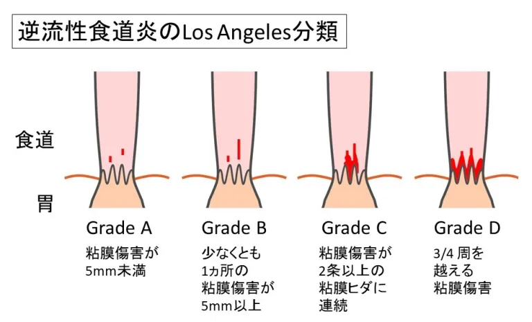 逆流性食道炎のLosAngeles分類