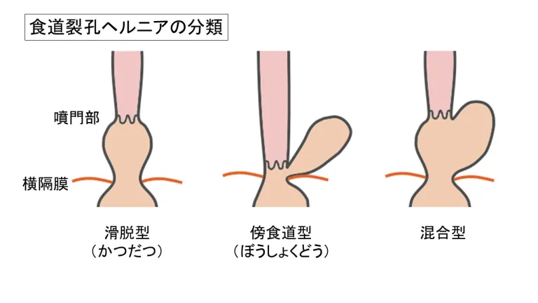 食道裂孔ヘルニアの分類