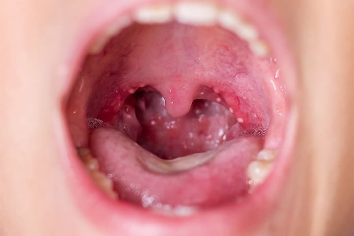 ヘルパンギーナ