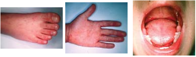 手足口病の症例写真