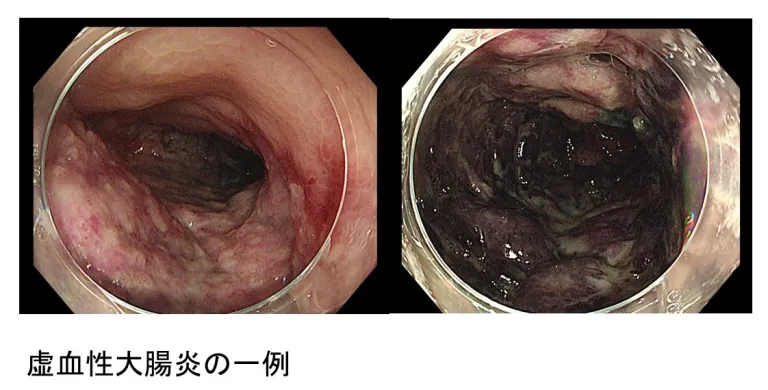 虚血性大腸炎の一例