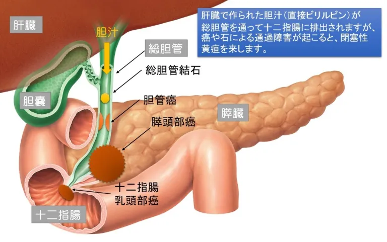 胆管癌、膵頭部癌、十二指腸乳頭部癌