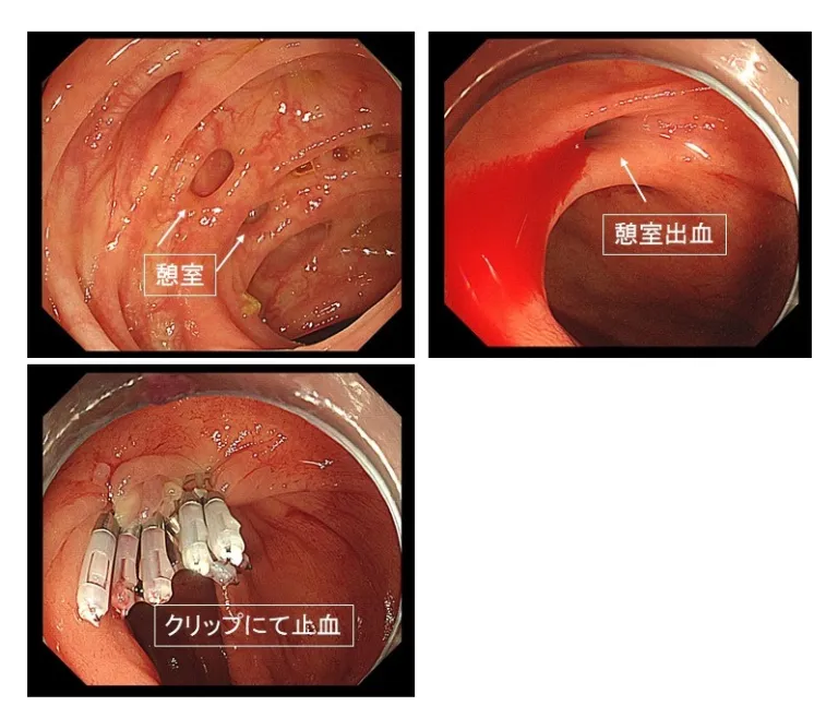 クリップ止血術にて止血できた上行結腸憩室出血の一例