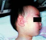 顔面にみられる発疹