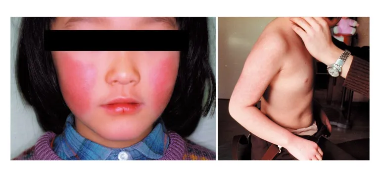 伝染性紅斑(リンゴ病)の症例写真