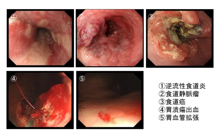 1.逆流性食道炎2.食道静脈瘤3.食道がん4.胃潰瘍出血5.胃血管拡張