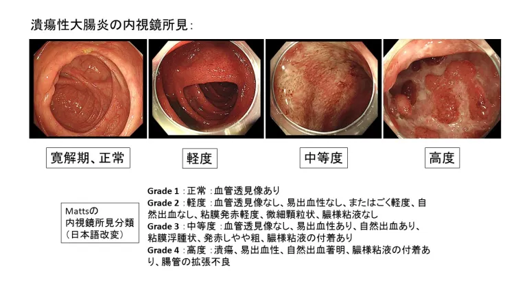潰瘍性大腸炎の内視鏡所見