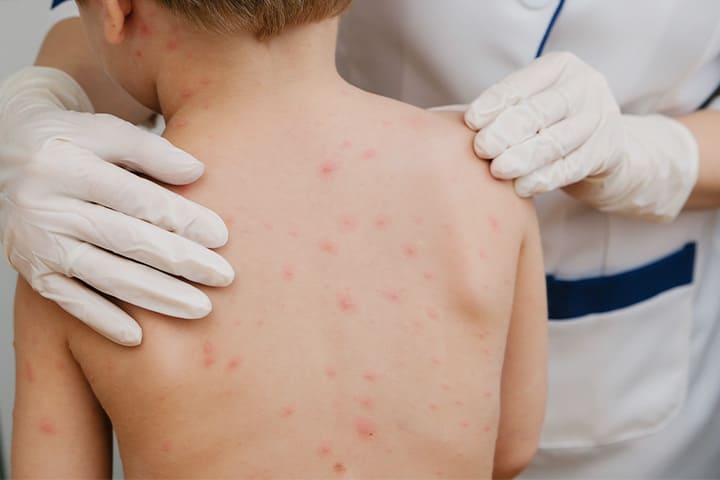 水痘（水ぼうそう）